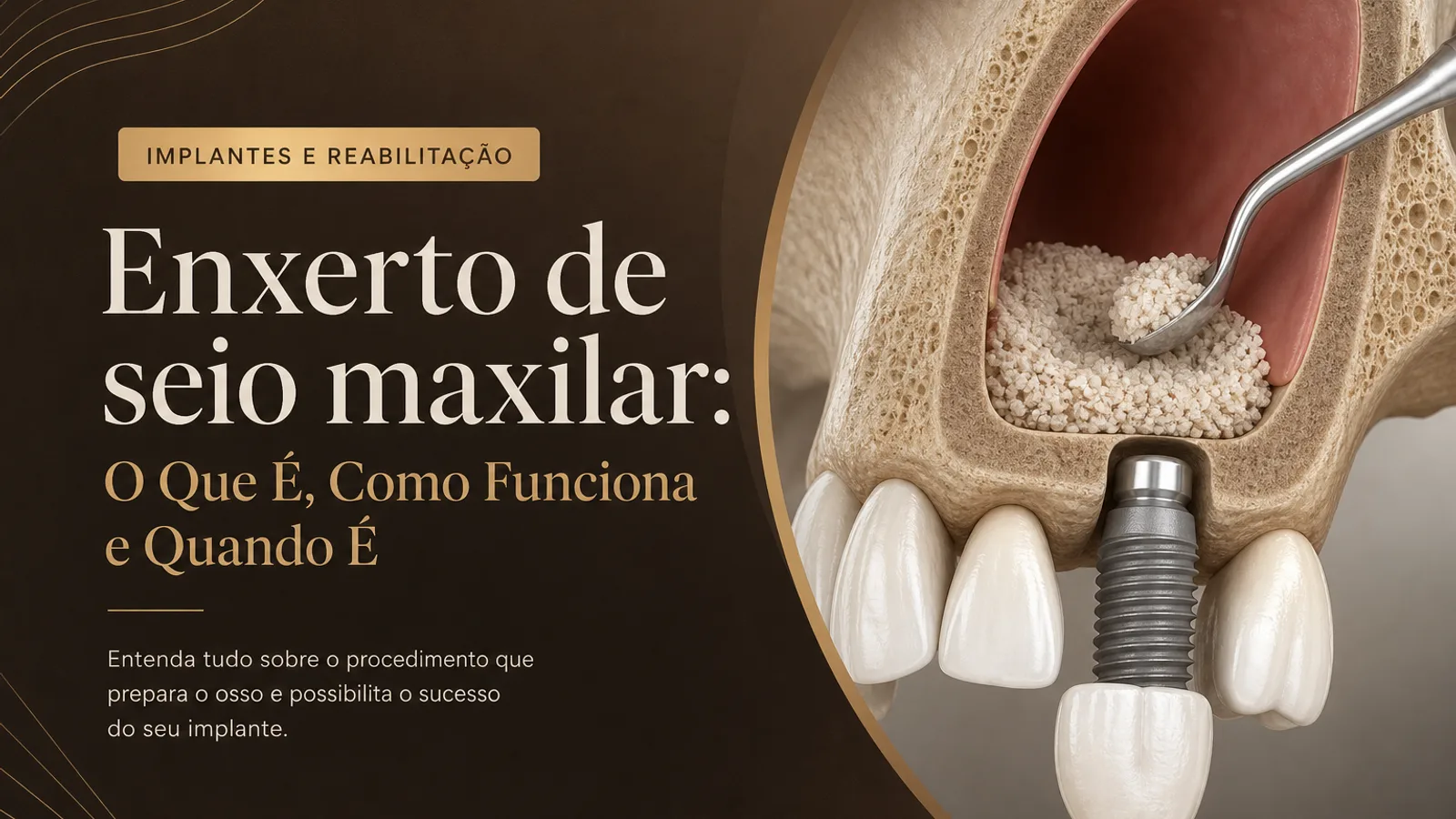 Enxerto de seio maxilar: O Que É, Como Funciona e Quando É