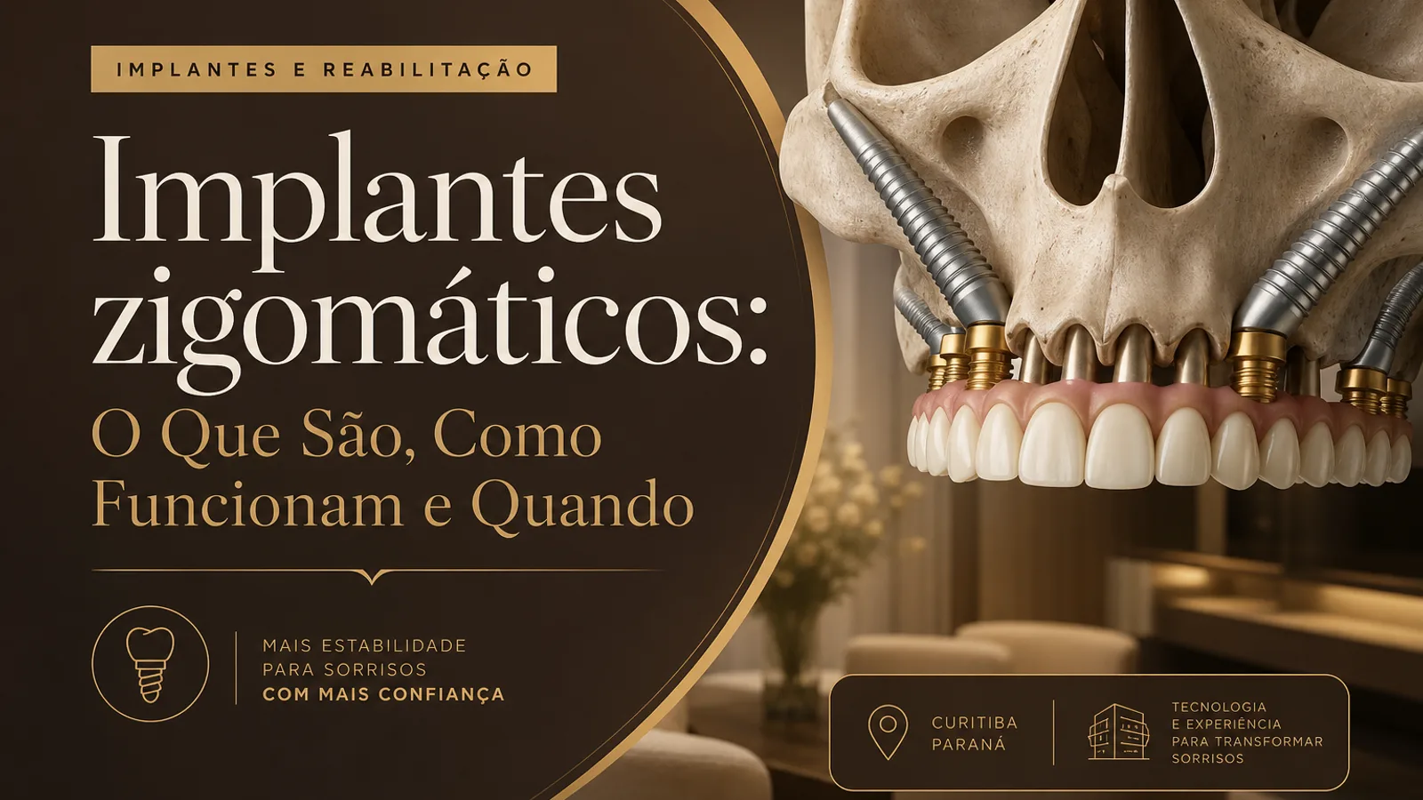 Implantes zigomáticos: O Que São, Como Funcionam e Quando