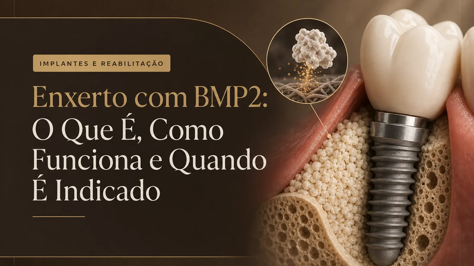 Enxerto com BMP2: O Que É, Como Funciona e Quando É Indicado