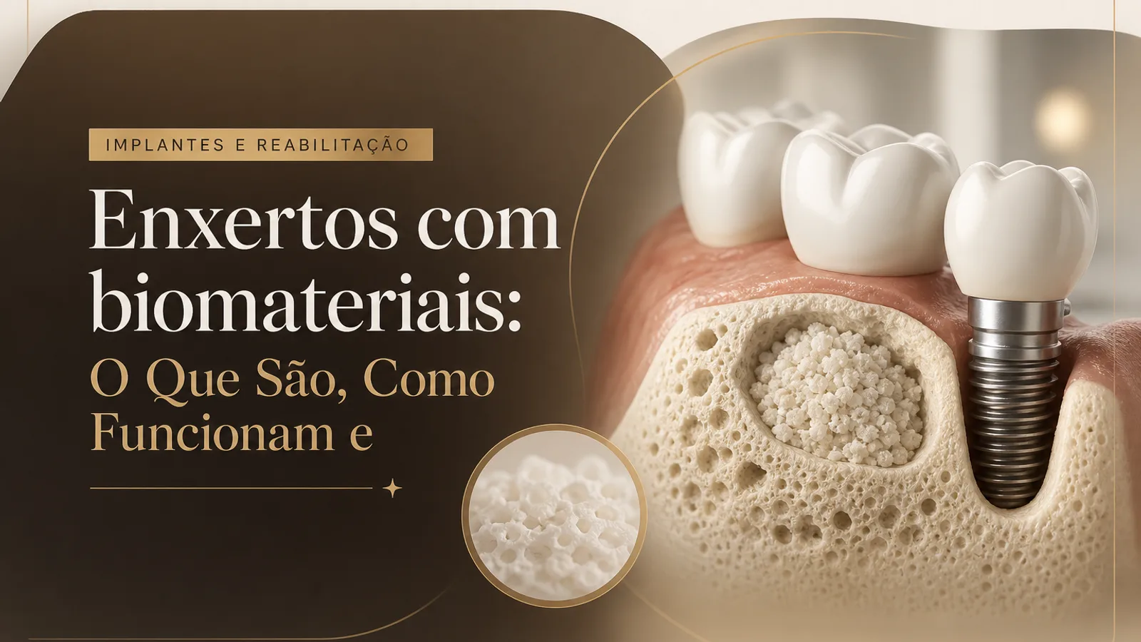 Enxertos com biomateriais: O Que São, Como Funcionam e
