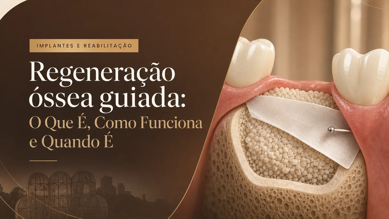 Regeneração óssea guiada: O Que É, Como Funciona e Quando É